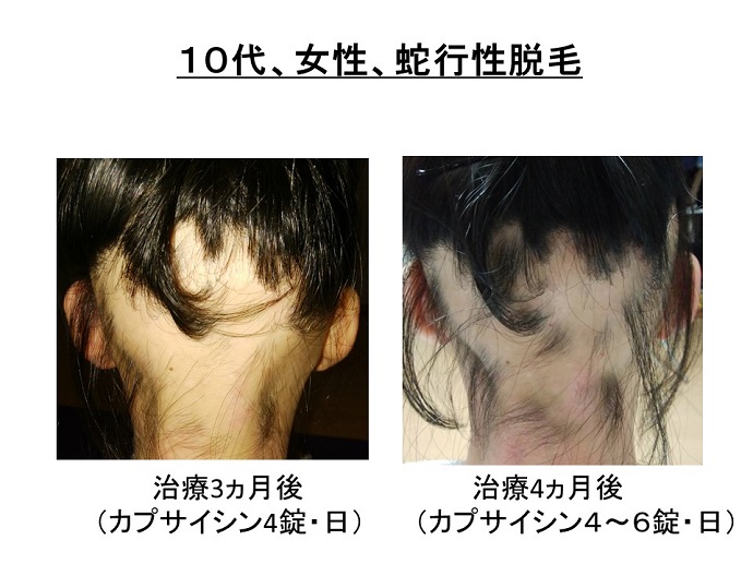 円形脱毛症　病院